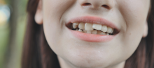 Dentes tortos: as consequências e como prevenir